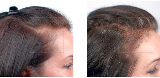 درمان ریزش مو با مواد طبیعی و گیاهی - جلوگیری از ریزش مو با مواد طبیعی و گیاهی